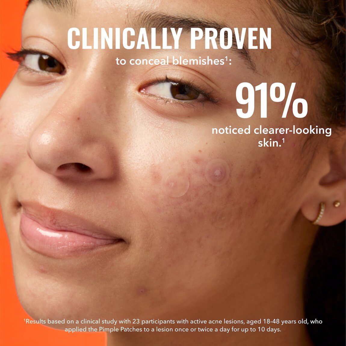 pimple-patches-u7 zb_p.jpg