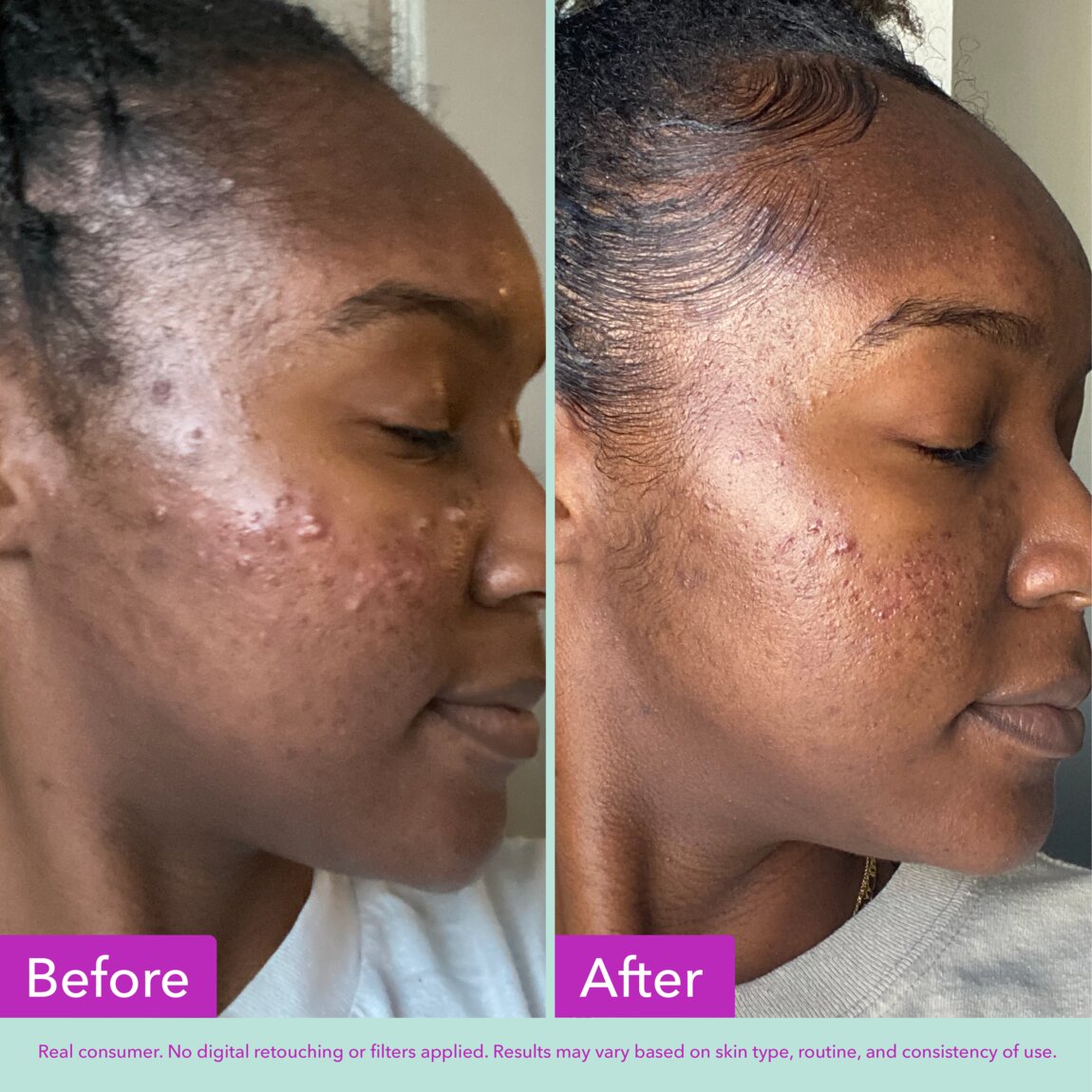 acne-foaming-cleanser-j3 zb_p.jpg